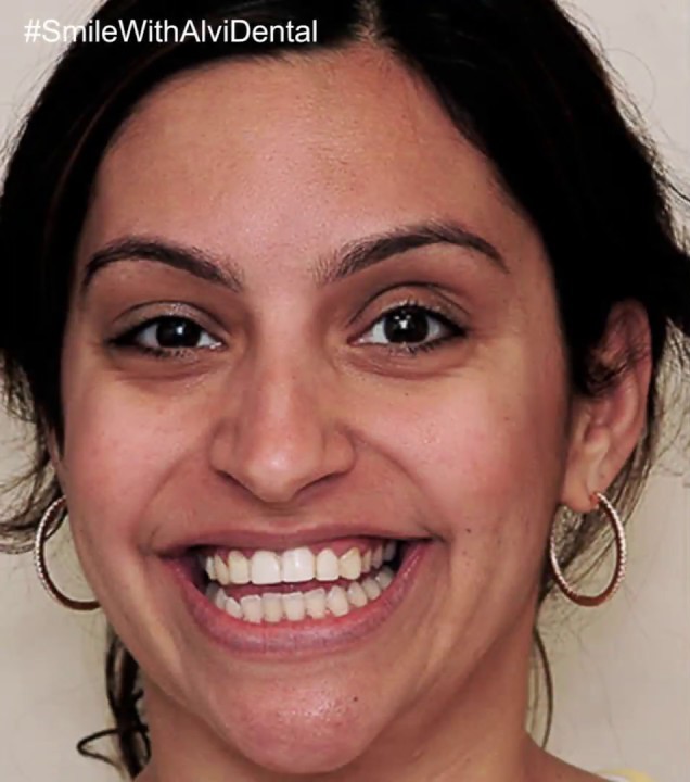 After dental veneers